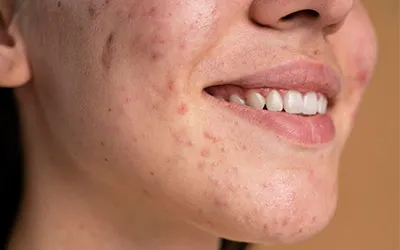 Acne Scar  Treatment in Ahmedabad