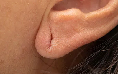 Ear Lobe Correction Treatment in Ahmedabad