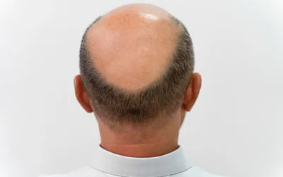 Hair Growth in Cancer Treatment in Ahmedabad