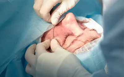 Sebaceous Cyst Removal Treatment in Ahmedabad