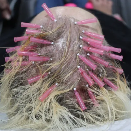 PDO Threading For Hair Growth