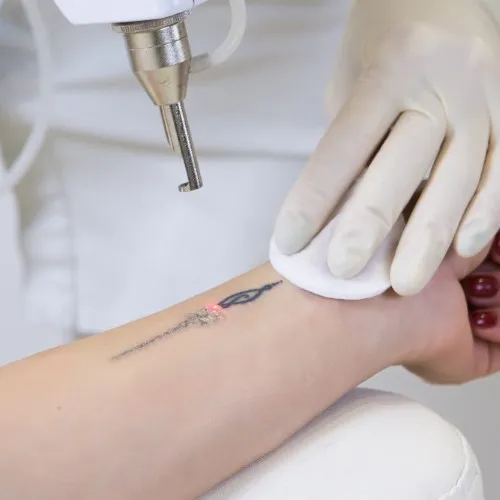 Laser Tattoo Removal