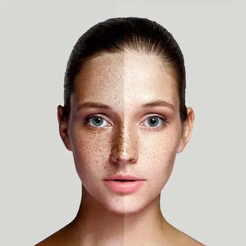 Hydrafacial