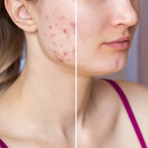 Acne Scar Treatment