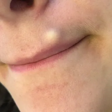 Sebaceous cyst removal