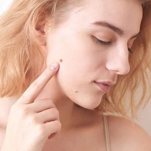 Mole & Skin Tag Removal
